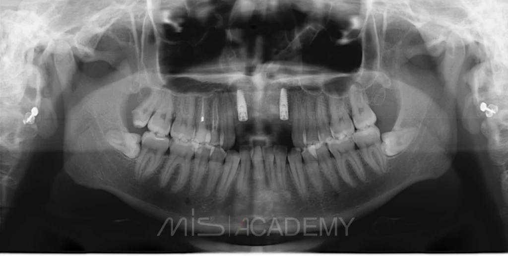 небная анестезия методика. резцовая анестезия внеротовым методом.