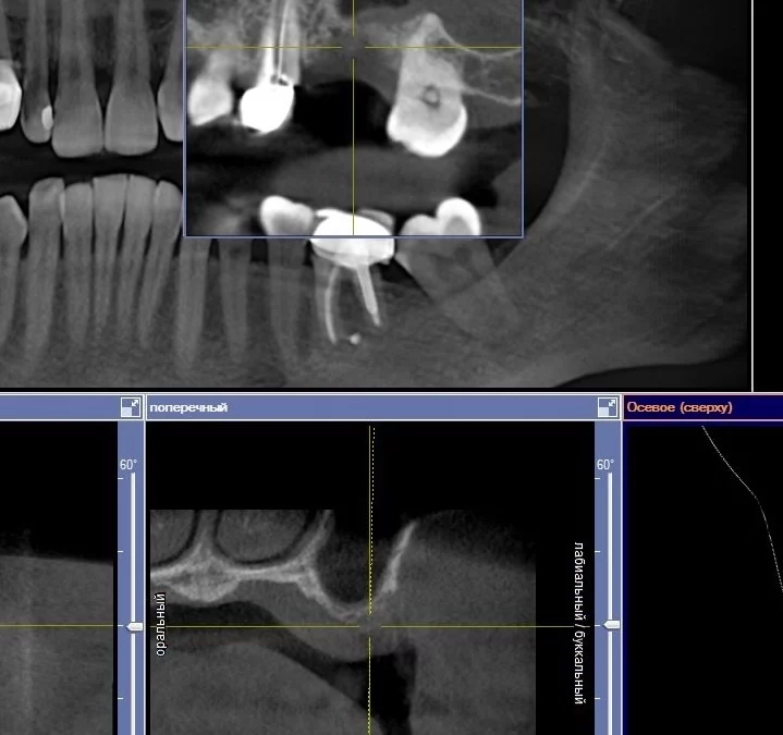 Махмуд Мазлум | Клинический кейс MM-11