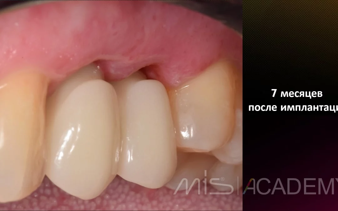 Татьяна Ковалева | Клинический кейс TK-70