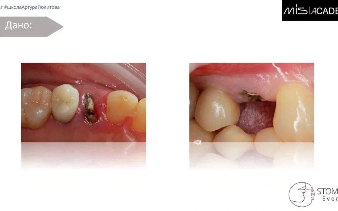 Артур Политов | Клинический кейс AP-77