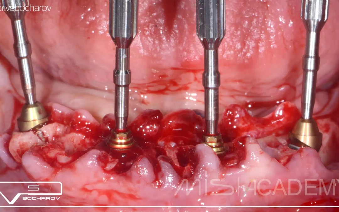 Василий Бочаров | Клинический кейс VB-64