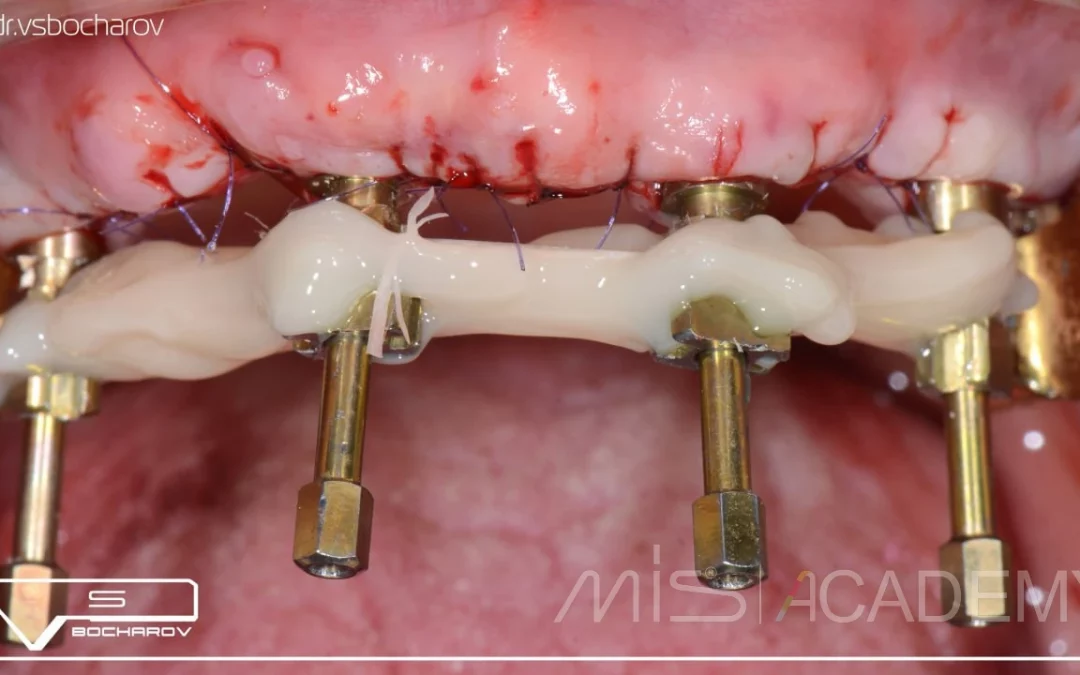 Василий Бочаров | Клинический кейс VB-63
